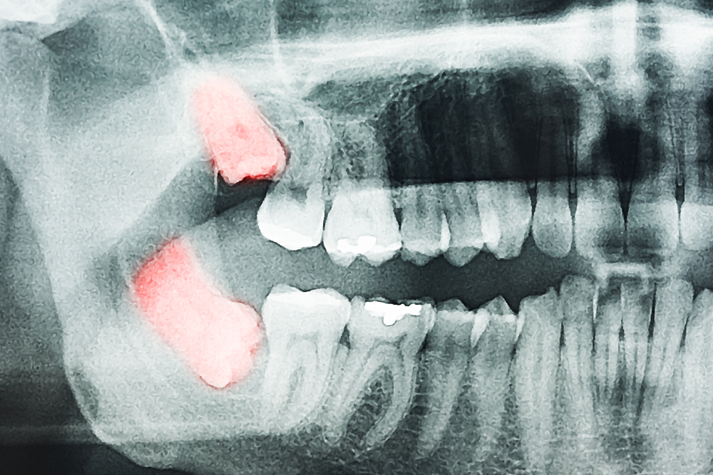 Какие могут быть осложнения после удаления зуба