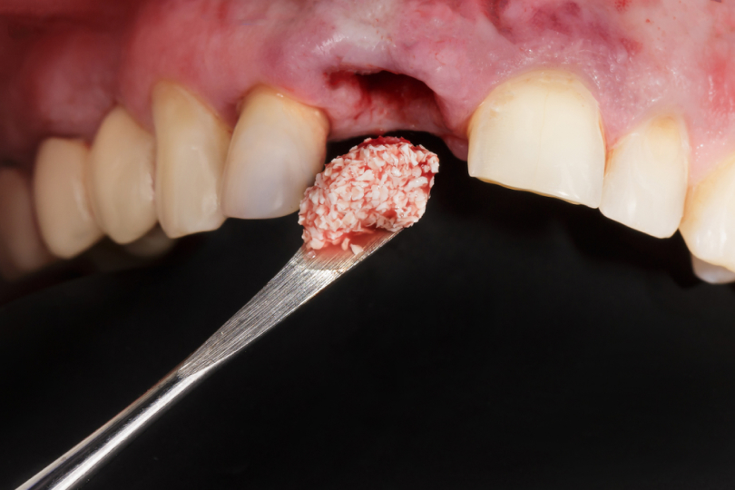 Имплантация зубов при атрофии костной ткани
